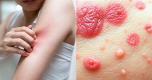 what cancer can cause itchy skin