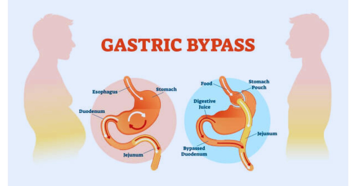 Gastric Sleeve Surgery
