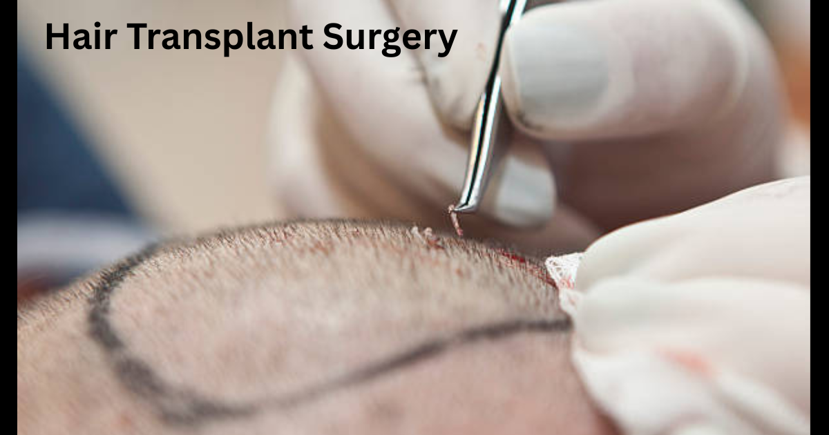Hair Transplant Surgery