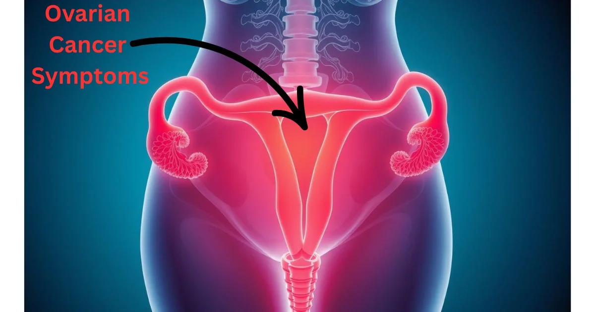 Ovarian Cancer